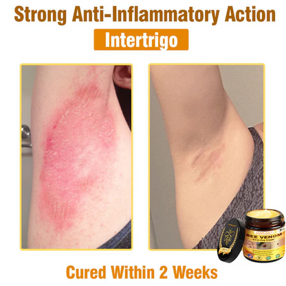 South Moon Bee Venom Pain Relief Cream for Arthritis, Muscle & Joint Discomfort (Original)